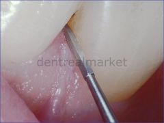 Tungsten Carpide Perio Frezi - 747L - Periodonti Frezi