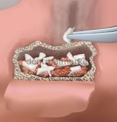 Biopad Collagen Sünger Cone - 10*10 cm SKT:02/2025