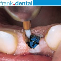 Gingiva Trimmer Yumuşak Doku Frezi - GT48L