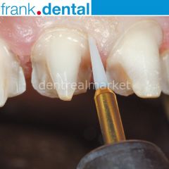 Gingiva Trimmer Yumuşak Doku Frezi - GT48L