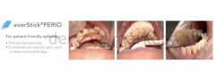 EverStick PERIO 2*12 cm - Fiber Takviyeli Periodontal Splintleme