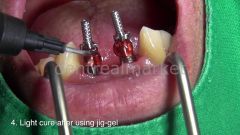 Jig Gel Işıkla Sertleşen Pattern Resin 12ml-(14gr) SKT:30/11/25