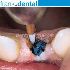 Gingiva Trimmer Yumuşak Doku Frez Seti
