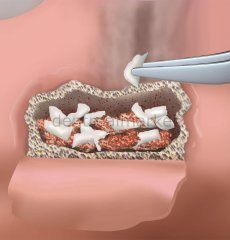 Biopad Collagen Sünger Cone - 5*5 cm - 3 Adet
