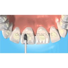 Orthodonotik Debonding Frez - Anguldruva 379AGK