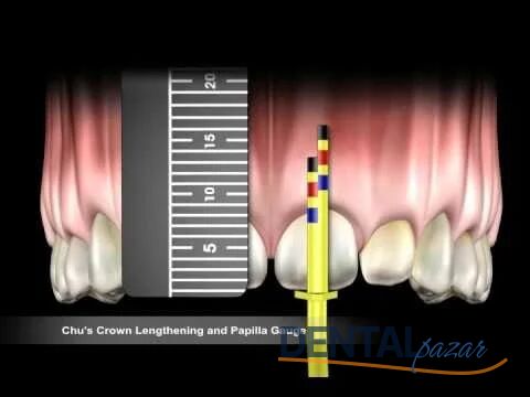 Chu's Crown Lengthening Gauge