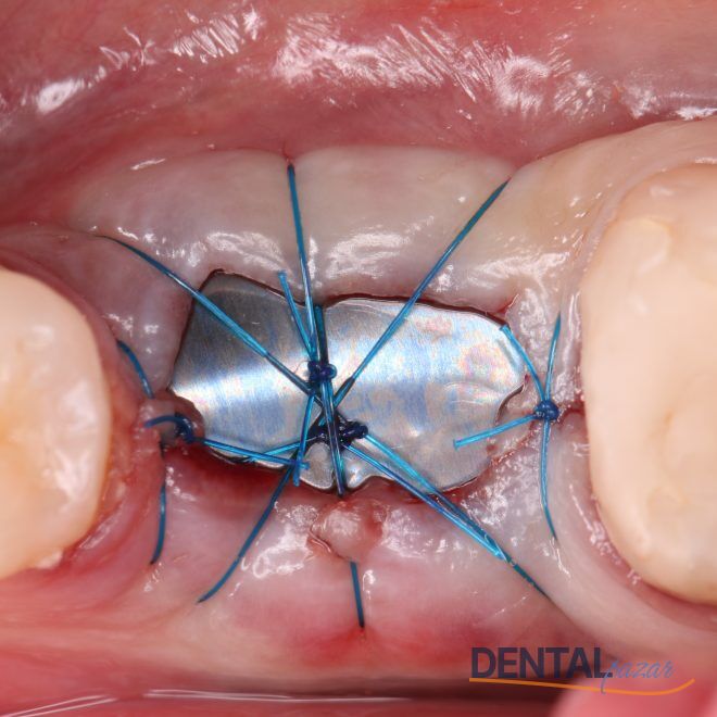 Surgitime Seal Titanium Mesh - Deliksiz - 34x25 mm Deliksiz