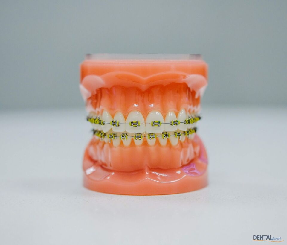 Ortho- LipGuard Braket Koruyucu