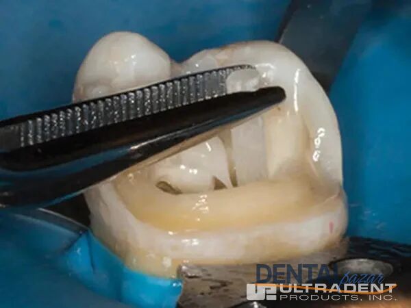 PermaFlo DC Rezin Siman Refil
