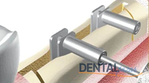 Crest Control Basic Kemik Genişletme