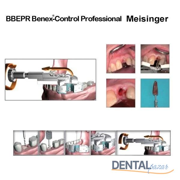 Benex Control Basic - Kök Çıkarma Sistemi