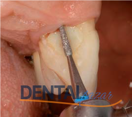 Periodontal Periodontitis Tedavi Frez Seti 1526