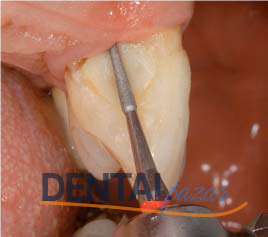 Periodontal Periodontitis Tedavi Frez Seti 1526