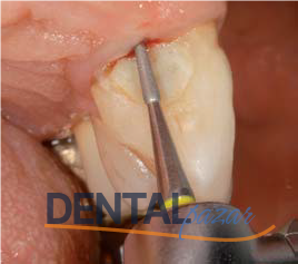 Periodontal Periodontitis Tedavi Frez Seti 1526