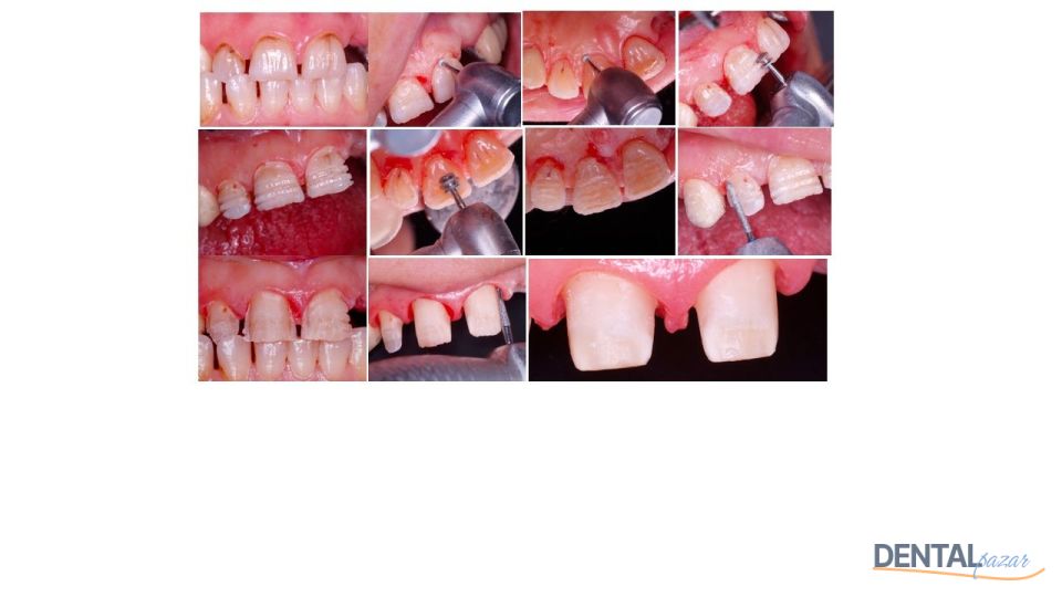Perfect Tooth Preparation Kesim Seti