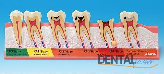 Caries Eğitim Modeli