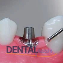 Implantgel Perio