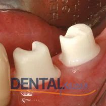 Implantgel Perio