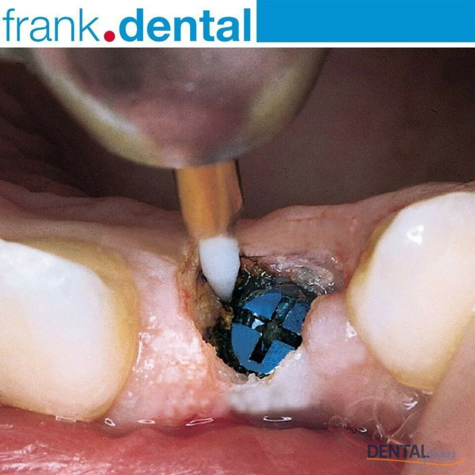 Gingiva Trimmer Yumuşak Doku Frezi - GT135