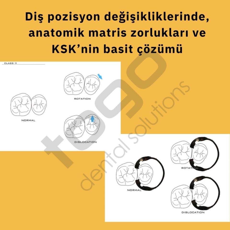 KSK Sectional Matrix (Böbrek Matris) Ring / Yüzük / Halka _ 2li Paket