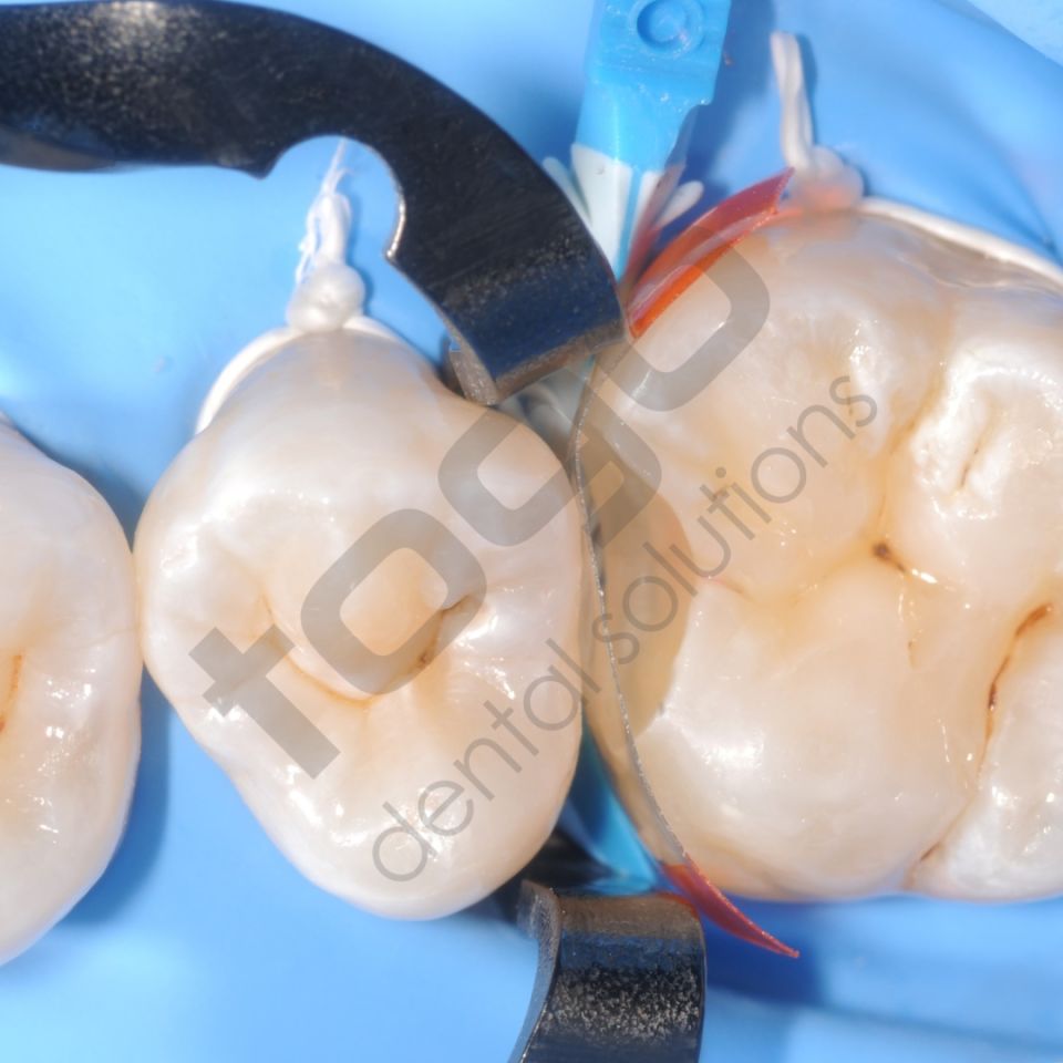 KSK Sectional Matrix (Böbrek Matris) Ring / Yüzük / Halka _ 2li Paket