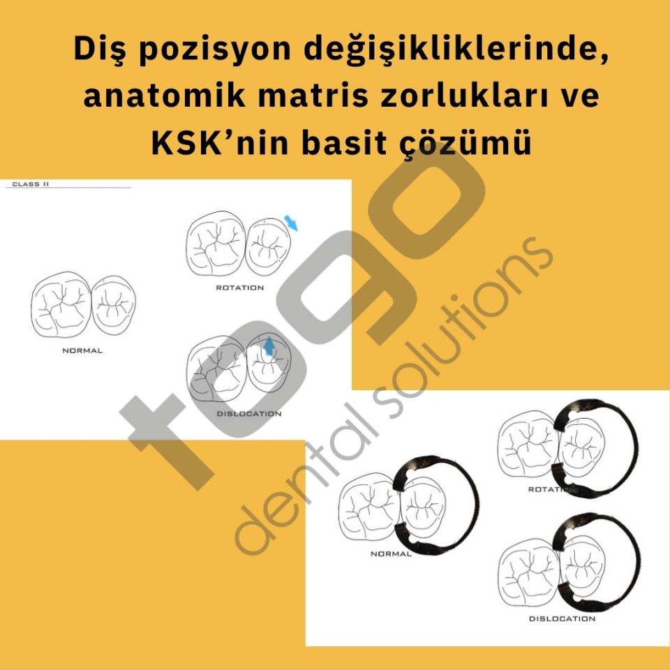 KSK Sectional Matrix (Böbrek Matris) Ring / Yüzük / Halka _ Tekli