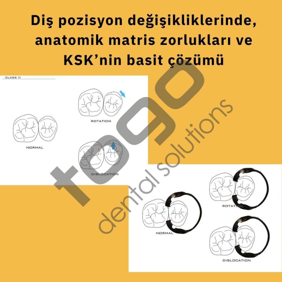 KSK Sectional Matrix (Böbrek Matris) Ring / Yüzük / Halka _ Set
