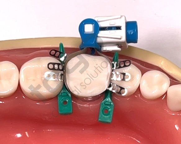Rhondium QuickConnect Anatomy Band Refill _ Molar_Tabbed(Kulaklıklı) _ Large_45 Adet