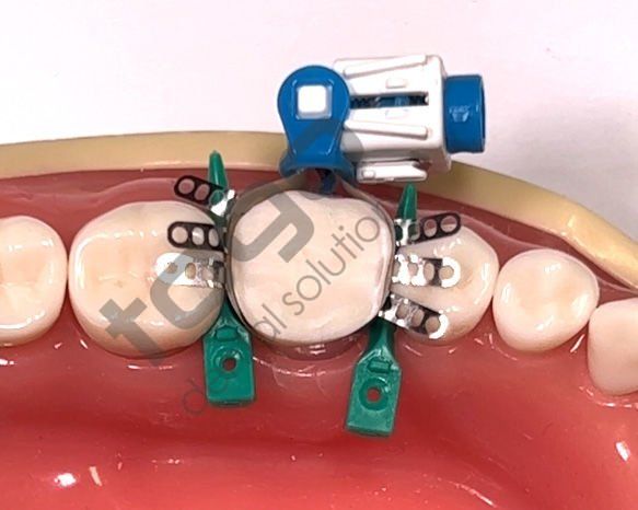 Rhondium QuickConnect Anatomy Band Refill _ Premolar_Tabbed(Kulaklıklı) _ Small_45 Adet