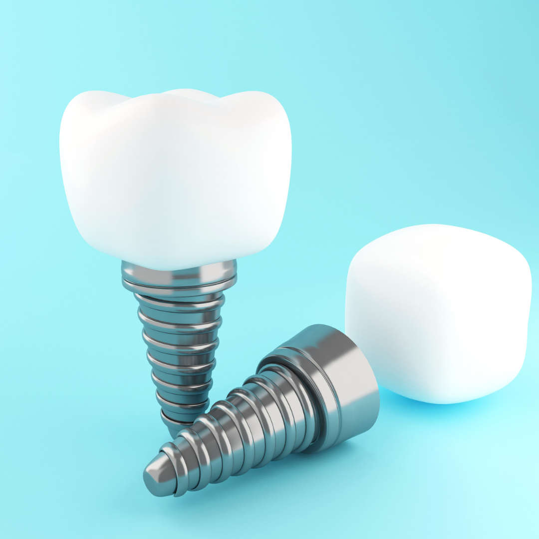 İmplant Diş Tedavisi Nedir?