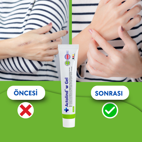 Actolind ® W Gel 50 ml | Yara İyileştirme Jeli