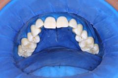 OptraDam Plus Assortment Pack
