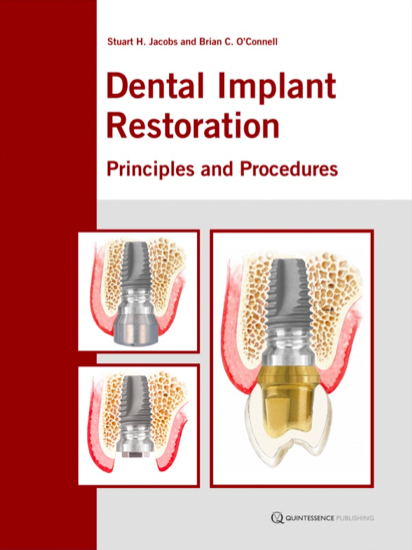 Dental Implant Restoration