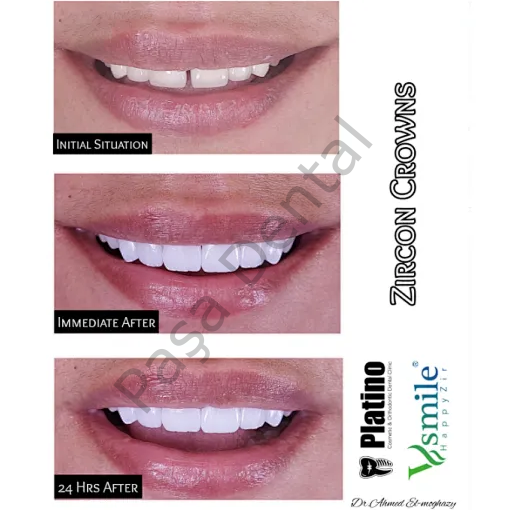 3D  Prism Dental  Zirkonyum Diski