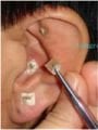 Kalıcı Kulak İğnesi Press Needle