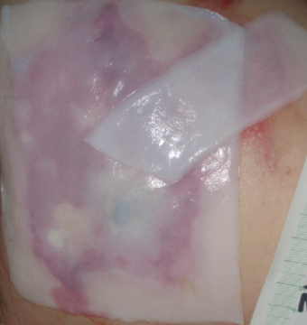 Lohmann Rauscher Suprasorb X PHMB 5x5 cm Yanık Ve Yara Örtüsü