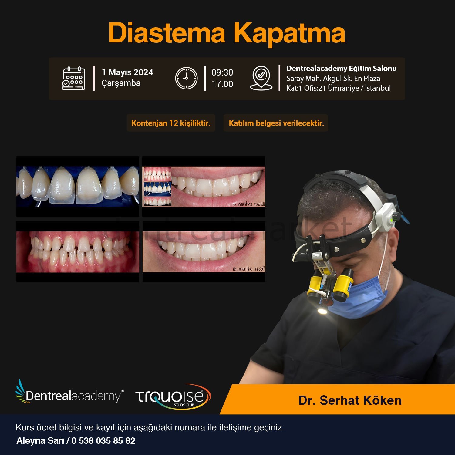 Diastema Kapatma - Dr. Serhat Köken