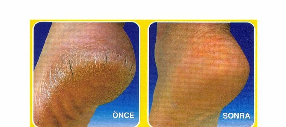 Duıt Ayak Topuk Çatlak Kremi 10g