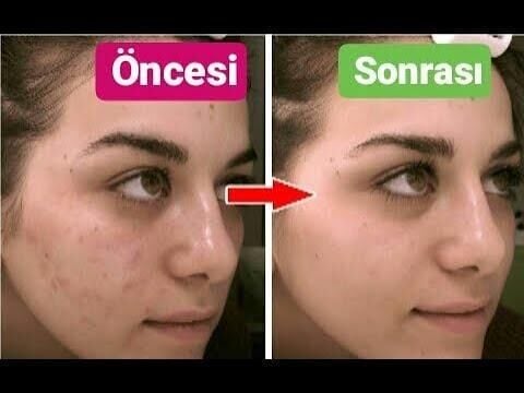 Arab Kızı Kremi Çil Sivilce Akne Leke Kremi Aydınlatıcı Pudra Etkili Pembe