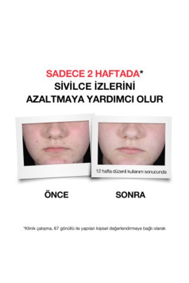 Neutrogena Sivilce Karşıtı Temizleme Jeli 200 Ml