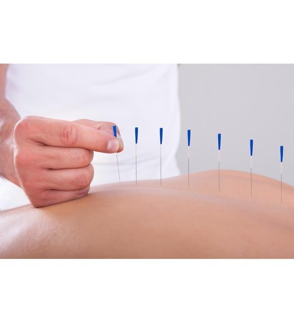 Akupunktur İğneleri: Geleneksel Tedavinin Modern Uygulaması